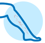 Deep Vein Thrombosis