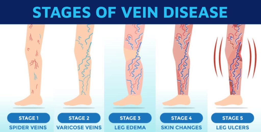 vein disease stages