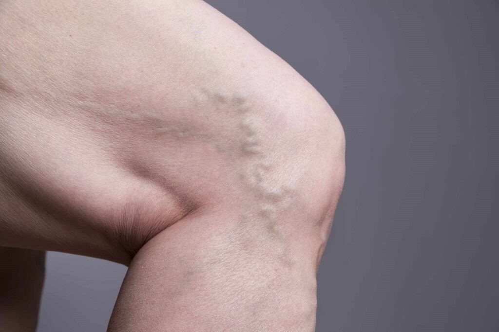 varicose veins