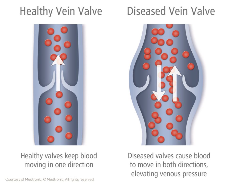 vein health