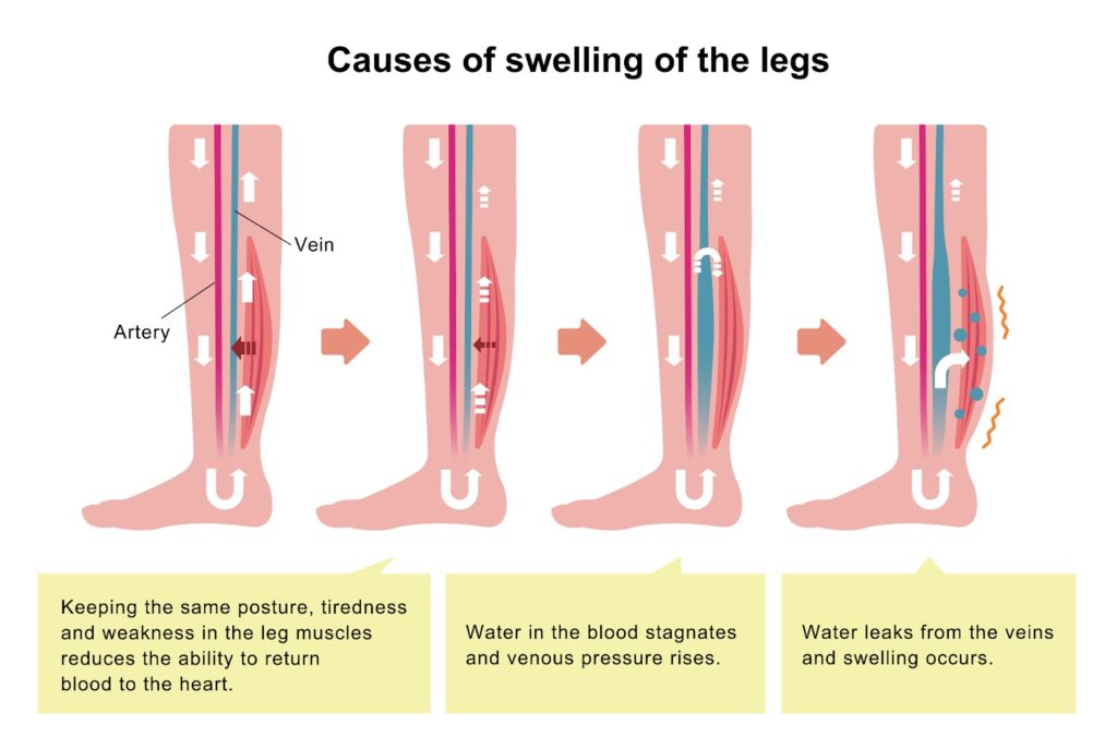 leg swelling