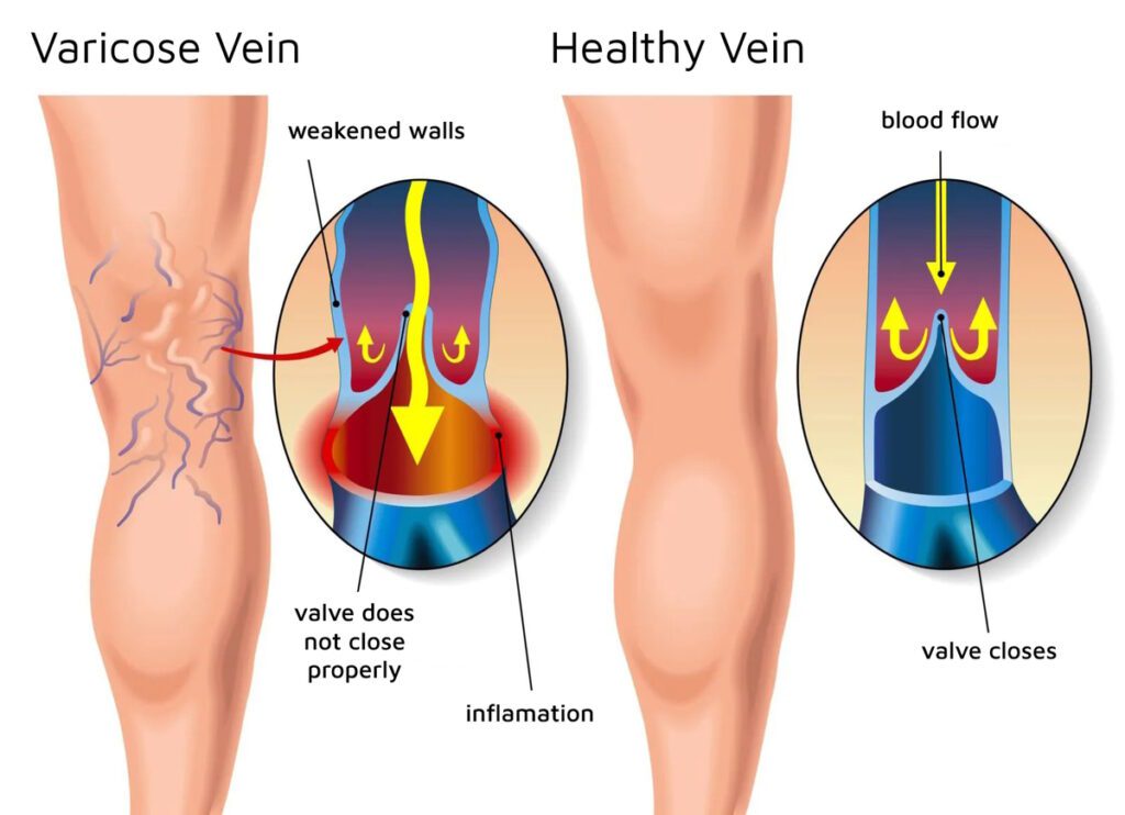 varicose vein graphic