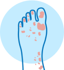 athlete's foot treatment