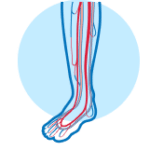 Critical Limb Ischemia (CLI)