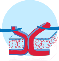 phlebectomy treatment