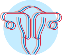 ovarian vein embolization