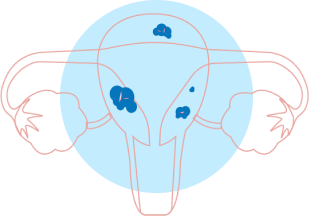 uterine fibroid embolization treatment