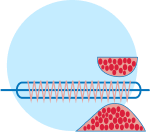 angioplasty