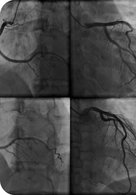 veins in xray