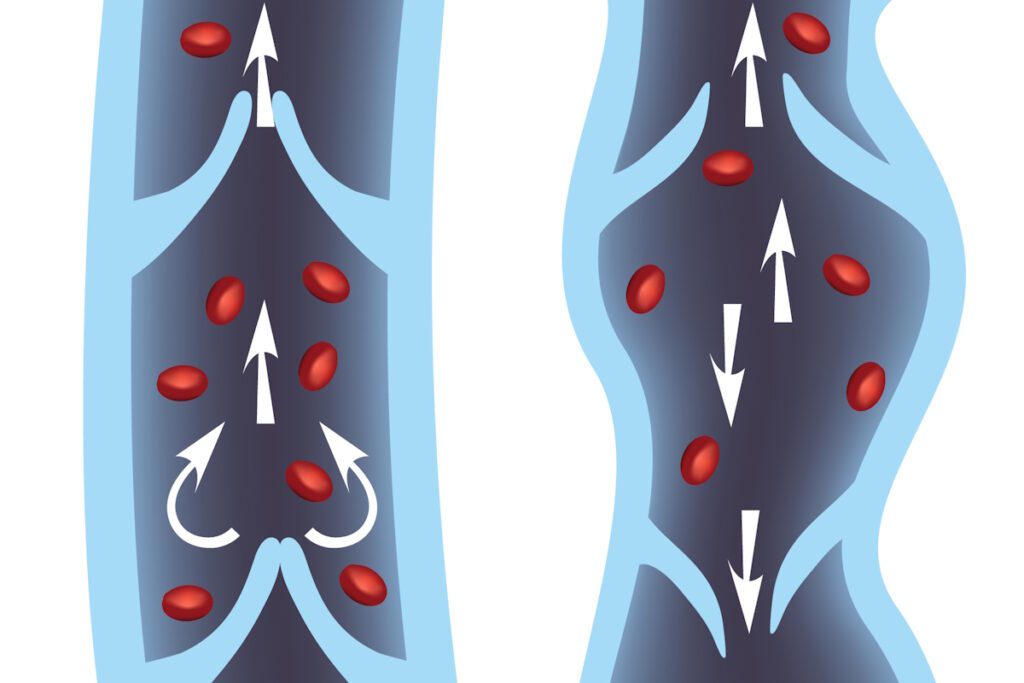 faulty valves in leg