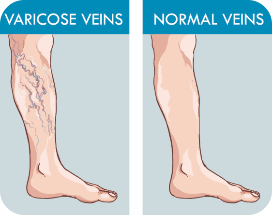 varicose vein illustration