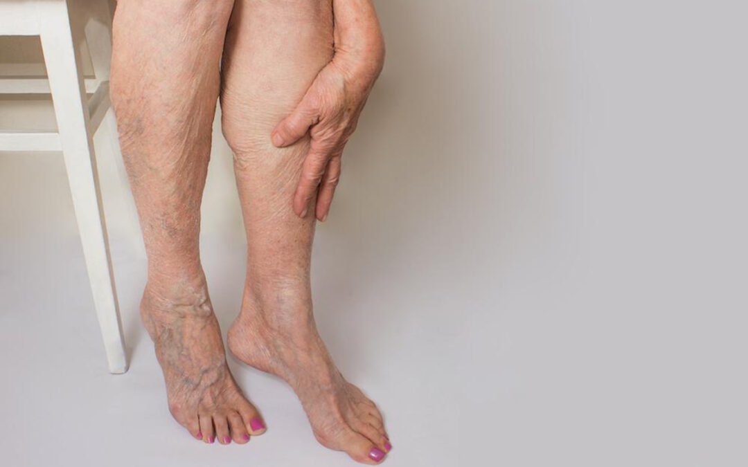 spider veins young women