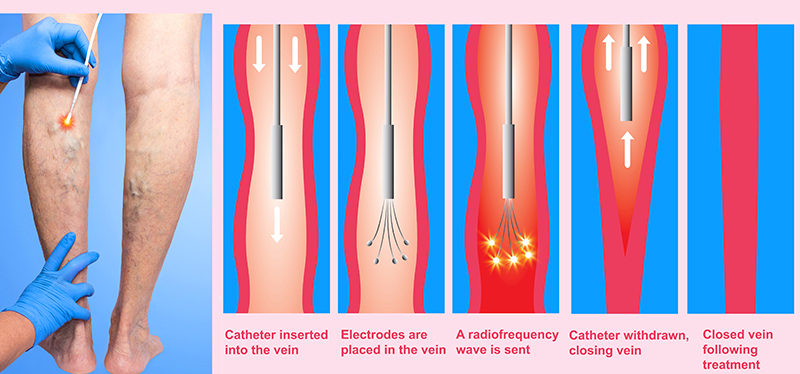 radiofrequency ablation faq