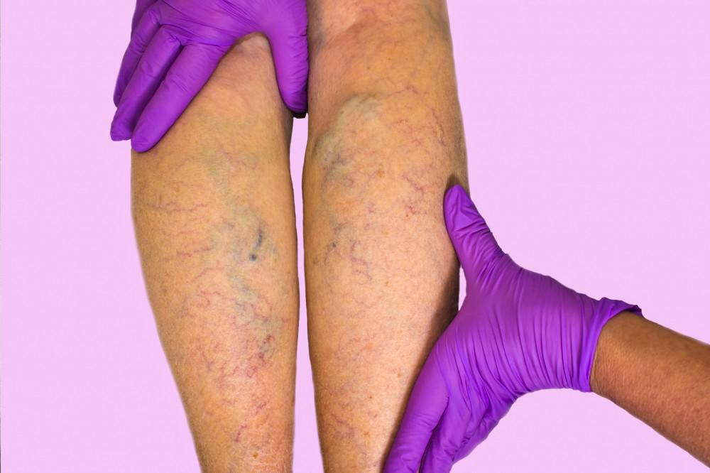 5 Vein Conditions That Cause Brown Spots On Legs - Vein