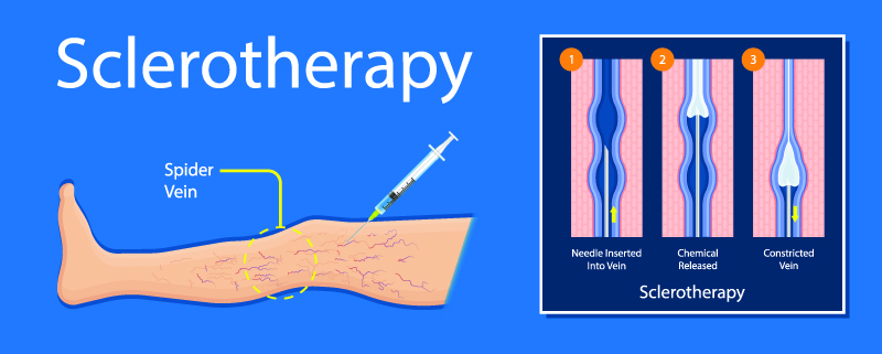 sclerotherapy