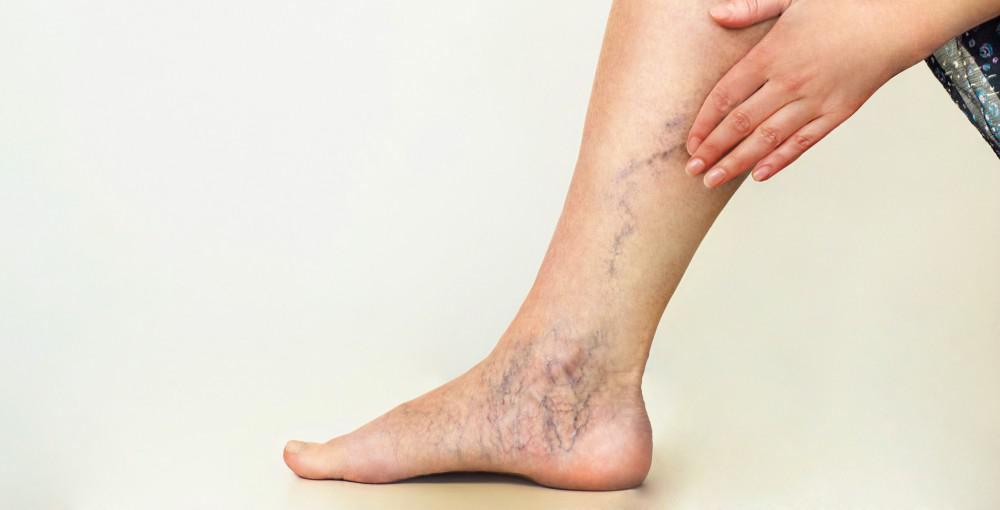 Sclerotherapy in The Woodlands, TX