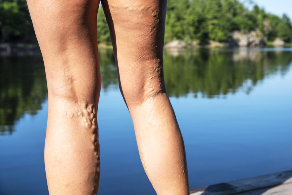 Varicose Veins: Exercise & Lifestyle Management - NuvoVivo: Reverse Your  Age & Lifestyle Diseases