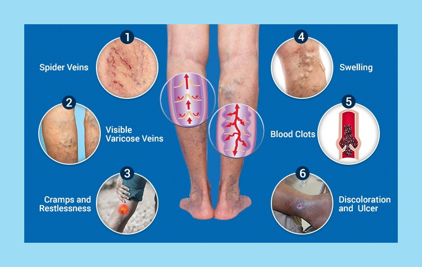 vein disease