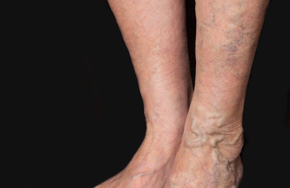 Vein Pain varicose veins