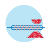 Venous Angioplasty