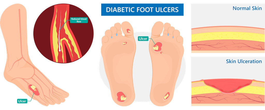 foot problems vascular related Illustration diabetic foot ulcers ss1762243145