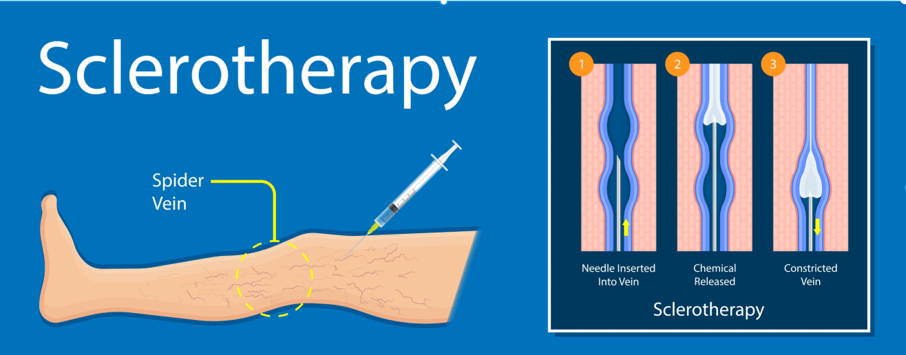 illustration sclerotherapy