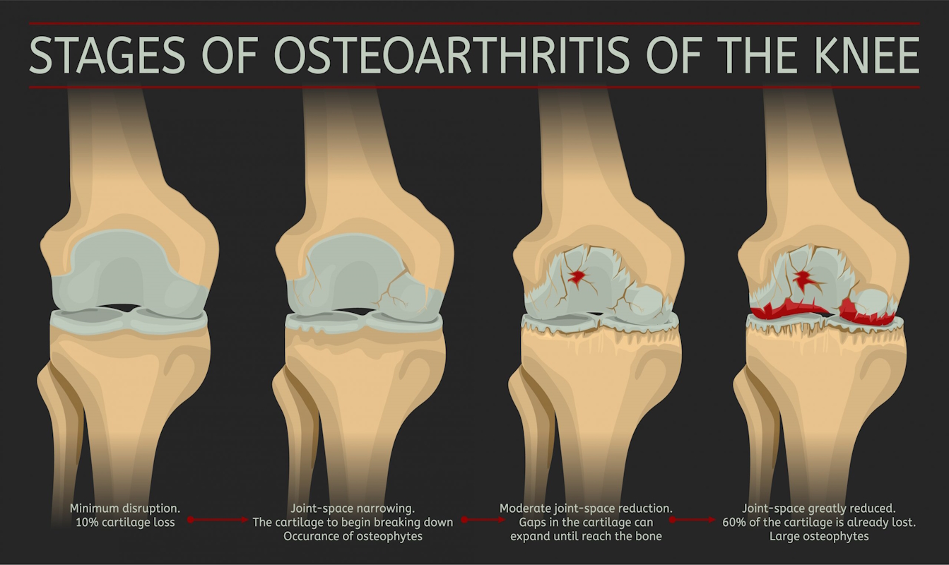 knee replacement surgery knee pain illustration stages of osteoarthritis of the knee ist1126528381 296623578