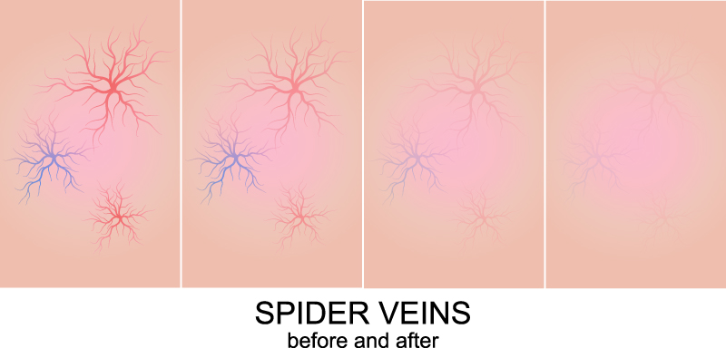 spider veins before after illustration