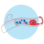 Venous Thrombectomy