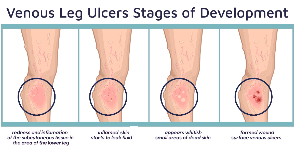 venous leg ulcers illustration venous ucers stages