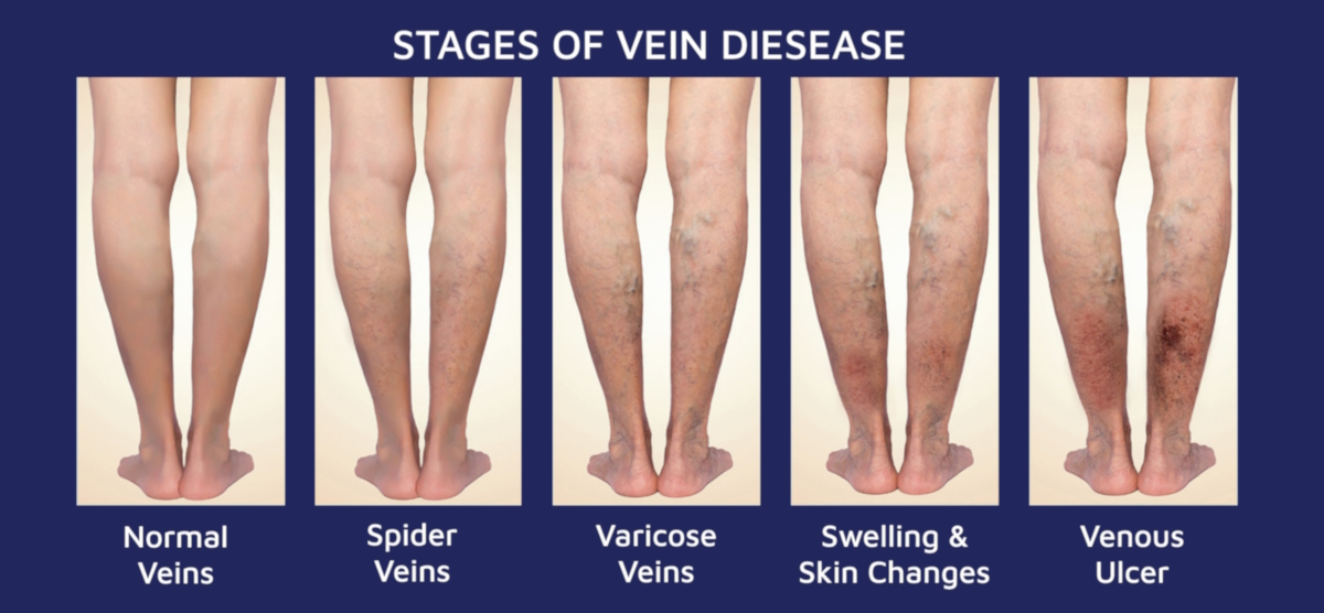 venous leg ulcers stages vein disease